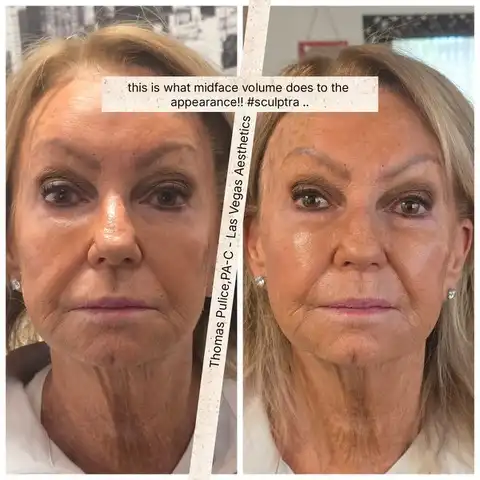 Sculptra midface volume before and after Las Vegas — collagen stimulation lifting and restoring facial volume at Las Vegas Aesthetics by Thomas Pulice PA-C