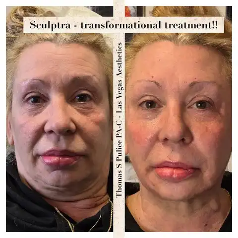 Sculptra transformational before and after Las Vegas — full face collagen restoration and volume at Las Vegas Aesthetics by Thomas Pulice PA-C